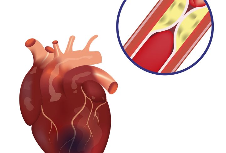 Coronary Artery Disease 1